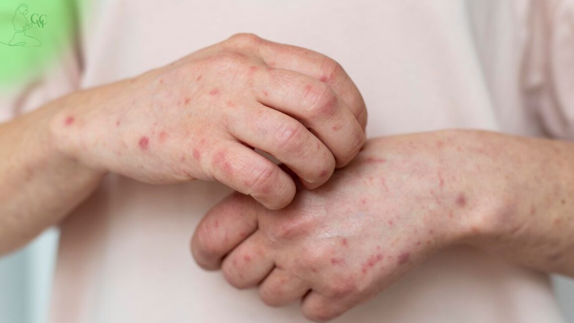 Criança com manchas de catapora sorrindo ao lado de um adulto atencioso
